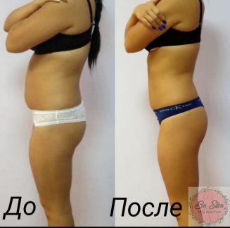 LPG массаж, аппаратная коррекция фигуры  Армавир