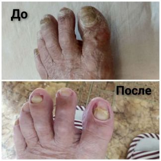 Педикюр проблемных стоп  Армавир