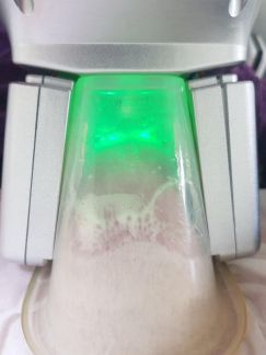 Криолиполиз  Армавир